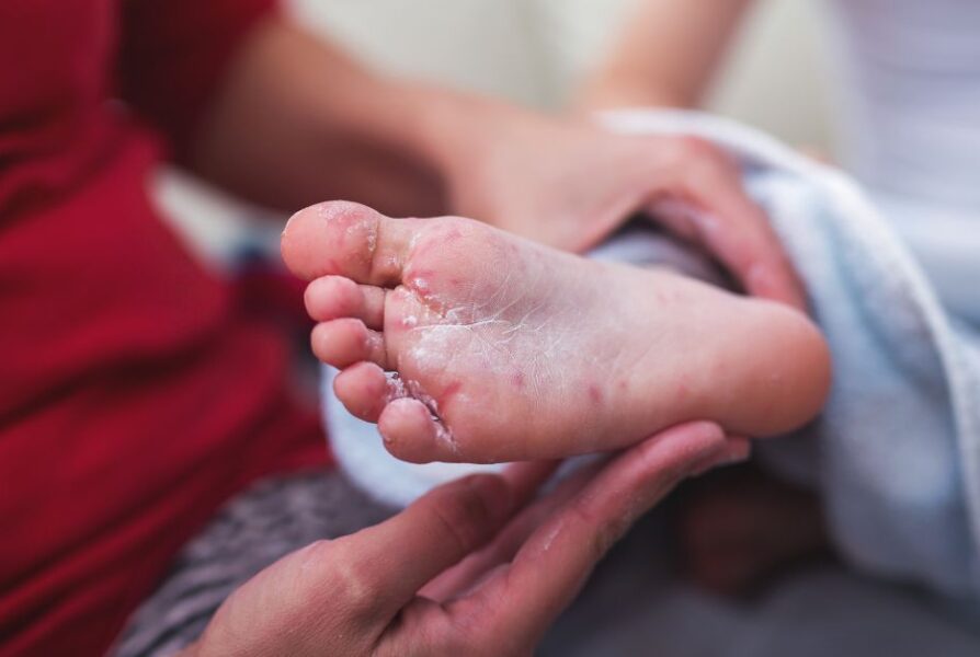 hand foot mouth disease